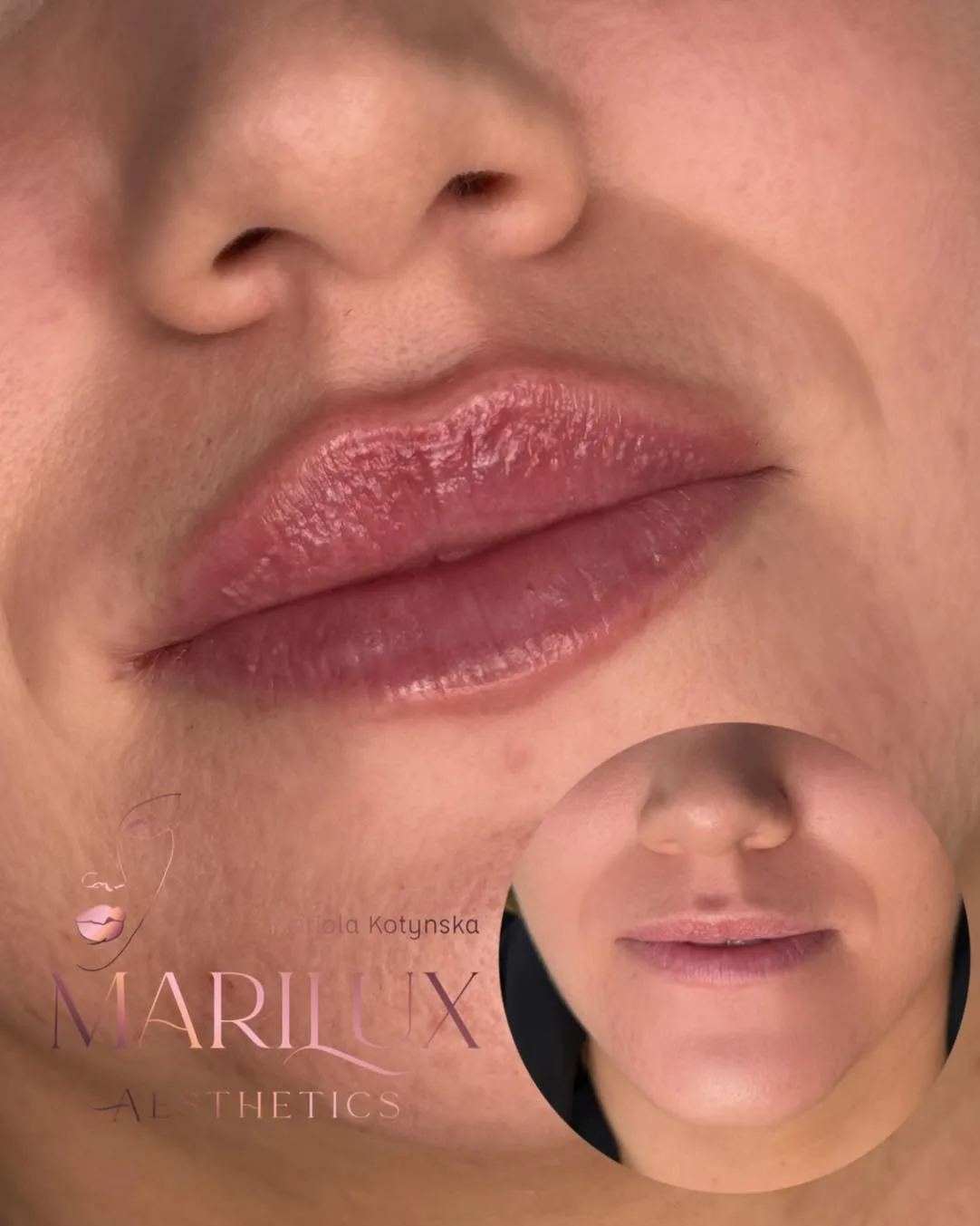Lip filler result 3 — beautiful lip enhancement